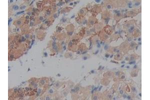 IHC-P analysis of Human Stomach cancer Tissue, with DAB staining. (Prekallikrein antibody  (AA 156-364))
