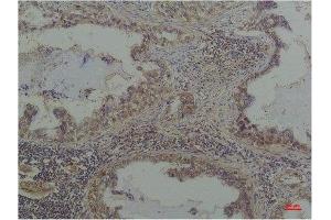 Immunohistochemistry (IHC) analysis of paraffin-embedded Human Lung Caricnoma using Phosphoserine Mouse mAb diluted at 1:200. (Phosphoserine antibody  (phosphorylated))