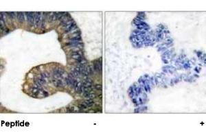 Immunohistochemical analysis of paraffin-embedded human colon carcinoma tissue using PLA2G4A polyclonal antibody . (PLA2G4A antibody)
