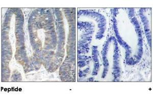 Immunohistochemical analysis of paraffin-embedded human colon carcinoma tissue using EIF2AK2 polyclonal antibody . (EIF2AK2 antibody)