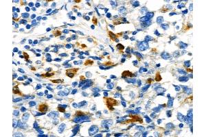 Phospho-STUB1/CHIP (Ser19) Antibody at 1/100 staining Human breast cancer by IHC-P.
