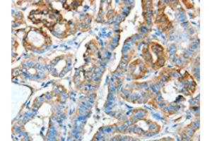 The image on the left is immunohistochemistry of paraffin-embedded Human thyroid cancer tissue using ABIN7128299(AGR3 Antibody) at dilution 1/15, on the right is treated with fusion protein. (AGR3 antibody)