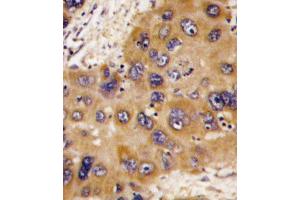 Formalin-fixed and paraffin-embedded human hepatocarcinoma tissue reacted with HNMT antibody , which was peroxidase-conjugated to the secondary antibody, followed by DAB staining. (HNMT antibody  (N-Term))
