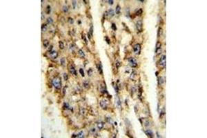 Formalin-fixed and paraffin-embedded human hepatocarcinoma reacted with DIO3 Antibody (C-term) followed which was peroxidase-conjugated to the secondary antibody, followed by DAB staining. (DIO3 antibody  (C-Term))