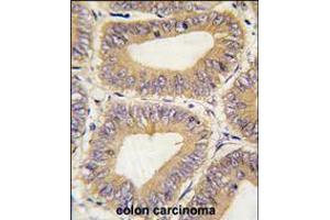 Formalin-fixed and paraffin-embedded human colon carcinoma tissue reacted with PHB2 Antibody , which was peroxidase-conjugated to the secondary antibody, followed by DAB staining. (Prohibitin 2 antibody  (C-Term))