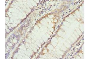 Immunohistochemistry of paraffin-embedded human colon cancer using ABIN7149608 at dilution of 1:100 (DHDDS antibody  (AA 1-333))