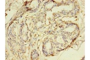 Immunohistochemistry of paraffin-embedded human breast cancer using ABIN7150765 at dilution of 1:100 (DUSP26 antibody  (AA 1-211))