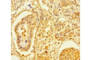 Immunohistochemistry of paraffin-embedded human pancreatic cancer using ABIN7172463 at dilution of 1:100 (TCF4 antibody  (AA 419-525))