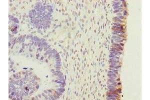 Immunohistochemistry of paraffin-embedded human ovarian cancer using ABIN7165317 at dilution of 1:100