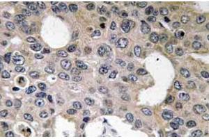 Immunohistochemistry (IHC) analyzes of CD124 / IL4R Antibody in paraffin-embedded human breast carcinoma tissue. (IL4 Receptor antibody)