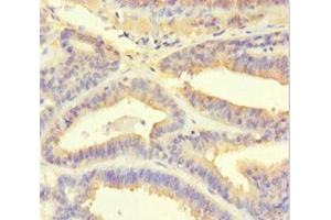 Immunohistochemistry of paraffin-embedded human endometrial cancer using ABIN7164935 at dilution of 1:100 (PSMF1 antibody  (AA 1-271))