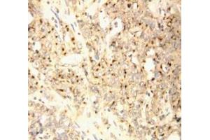 Anti-XAF1 antibody, IHC(P) IHC(P): Human Endometrial Carcinoma Tissue (XAF1 antibody  (C-Term))