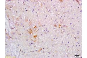 Formalin-fixed and paraffin embedded human colon carcinoma labeled with Rabbit Anti ApoB/Apolipoprotein B Polyclonal Antibody, Unconjugated (ABIN872950) at 1:200 followed by conjugation to the secondary antibody and DAB staining (APOB antibody  (AA 1501-1700))