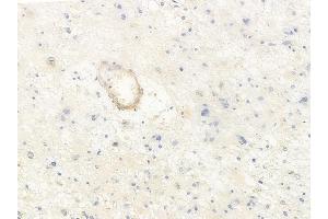 ABIN6265616 and ABIN6278288 at 1/100 staining human astrocytoma by IHC-P. (TMOD2 antibody  (N-Term))