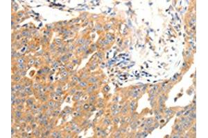 The image on the left is immunohistochemistry of paraffin-embedded Human ovarian cancer tissue using ABIN7190491(DOPEY1 Antibody) at dilution 1/25, on the right is treated with synthetic peptide. (DOPEY1 antibody)