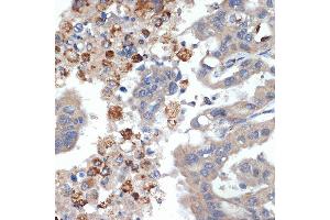 Immunohistochemistry of paraffin-embedded human liver cancer using PRSS2 Rabbit mAb (ABIN7269580) at dilution of 1:100 (40x lens). (PRSS2 antibody)