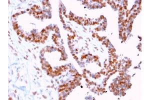 Formalin-fixed, paraffin-embedded human Prostate Carcinoma stained with CLEC9A Mouse Monoclonal Antibody (2H12/4). (DMC1 antibody)