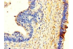 Immunohistochemistry of paraffin-embedded human ovarian cancer using ABIN7155505 at dilution of 1:100 (WHSC1L1 antibody  (AA 1-645))