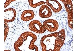 Formalin-fixed, paraffin-embedded human colon carcinoma stained with Cytokeratin 18 antibody (KRT18/834). (Cytokeratin 18 antibody)