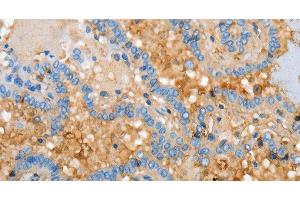 Immunohistochemistry of paraffin-embedded Human thyroid cancer using APOH Polyclonal Antibody at dilution of 1:30 (APOH antibody)