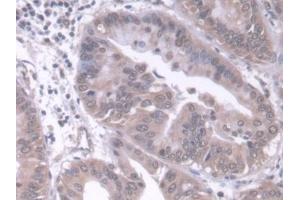 Detection of RARb in Human Liver cancer Tissue using Polyclonal Antibody to Retinoic Acid Receptor Beta (RARb) (Retinoic Acid Receptor beta antibody  (AA 205-451))