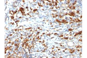 Formalin-fixed, paraffin-embedded human Lymphoma stained with CD79a Mouse Monoclonal Antibody (IGA/764) (CD79a antibody)