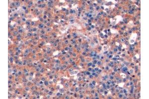 Detection of CD19 in Human Lymphoma Tissue using Polyclonal Antibody to Cluster Of Differentiation 19 (CD19) (CD19 antibody  (AA 160-258))