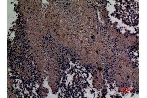 Immunohistochemistry (IHC) analysis of paraffin-embedded Human Lung Cancer, antibody was diluted at 1:100. (MCL-1 antibody  (Internal Region))