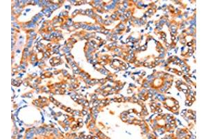 The image on the left is immunohistochemistry of paraffin-embedded Human thyroid cancer tissue using ABIN7192314(SEPT4 Antibody) at dilution 1/50, on the right is treated with synthetic peptide. (Septin 4 antibody)