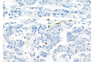 ABIN6264974 and ABIN6276799 at 1/100 staining Human liver cancer by IHC-P. (SELPLG antibody  (N-Term))