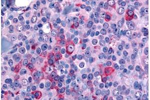Anti-NANP antibody  ABIN1049088 IHC staining of human breast, carcinoma.
