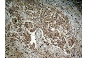 Immunohistochemical analysis of paraffin-embedded human lung carcinoma tissue, using Akt (Phospho-Thr308) Antibody. (AKT1 antibody  (pThr308))