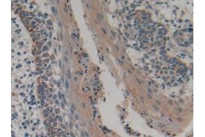 Detection of PLA2G4 in Human Skin cancer Tissue using Polyclonal Antibody to Cytosolic Phospholipase A2 (PLA2G4) (PLA2G4A antibody  (AA 563-749))
