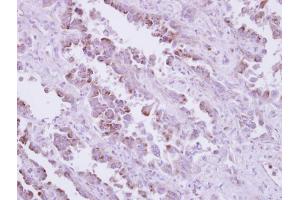 IHC-P Image Immunohistochemical analysis of paraffin-embedded human lung cancer, using TLR9, antibody at 1:250 dilution. (TLR9 antibody  (N-Term))