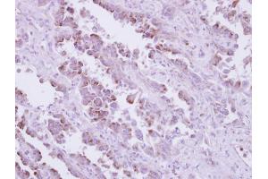 IHC-P Image Immunohistochemical analysis of paraffin-embedded human lung cancer, using TLR9, antibody at 1:250 dilution.