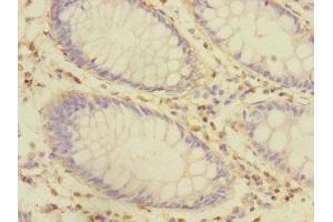 Immunohistochemistry of paraffin-embedded human colon cancer using ABIN7149052 at dilution of 1:100 (CRIP1 antibody  (AA 1-77))