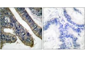 Immunohistochemistry analysis of paraffin-embedded human colon carcinoma, using c-PLA2 (Phospho-Ser505) Antibody. (C-PLA2 (AA 471-520), (pSer505) antibody)