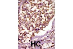 Formalin-fixed and paraffin-embedded human hepatocellular carcinoma tissue reacted with BMX polyclonal antibody  , which was peroxidase-conjugated to the secondary antibody, followed by AEC staining. (BMX antibody  (Internal Region))