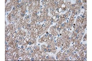 Immunohistochemical staining of paraffin-embedded Carcinoma of Human liver tissue using anti-MTRF1L mouse monoclonal antibody.