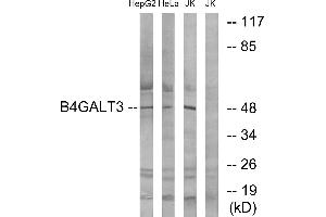 Immunohistochemistry analysis of paraffin-embedded human liver carcinoma tissue using B4GALT3 antibody. (B4GALT3 antibody)