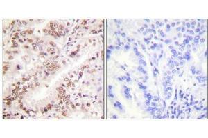 Immunohistochemical analysis of paraffin-embedded human lung carcinoma tissue using Estrogen Receptor-α (Phospho-Tyr537) antibody (left)or the same antibody preincubated with blocking peptide (right). (Estrogen Receptor alpha antibody  (pTyr537))