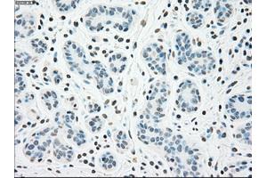 Immunohistochemical staining of paraffin-embedded breast tissue using anti-CHEK2 mouse monoclonal antibody.