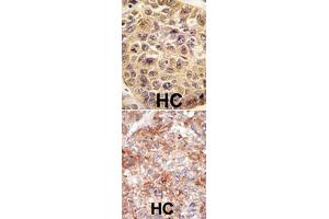 (TOP) Formalin-fixed and paraffin-embedded human hepatocellular carcinoma reacted with UBB polyclonal antibody  , which was peroxidase-conjugated to the secondary antibody, followed by DAB staining. (Ubiquitin B antibody  (N-Term))