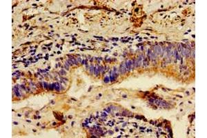 Immunohistochemistry of paraffin-embedded human lung cancer using ABIN7157824 at dilution of 1:100 (LCT antibody  (AA 983-1252))