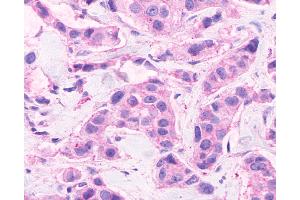 Anti-CELSR2 antibody IHC of human Breast, Carcinoma. (CELSR2 antibody  (C-Term))