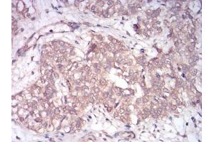 Immunohistochemical analysis of paraffin-embedded bladder cancer tissues using Rab13 mouse mAb with DAB staining. (RAB13 antibody  (AA 66-200))