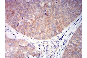 Immunohistochemical analysis of paraffin-embedded bladder cancer tissues using CHRNA6 mouse mAb with DAB staining.
