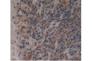 Detection of GDF3 in Human Lung Cancer Tissue using Monoclonal Antibody to Growth Differentiation Factor 3 (GDF3) (GDF3 antibody  (AA 251-364))