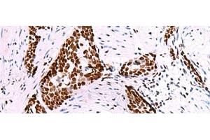 Immunohistochemistry of paraffin-embedded Human esophagus cancer tissue using TRIM28(phospho-Ser824) Polyclonal Antibody at dilution of 1:50(x200) (KAP1 antibody  (pSer824))