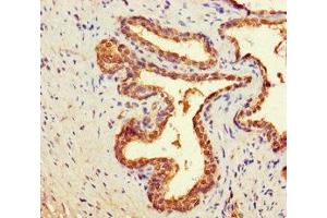 Immunohistochemistry of paraffin-embedded human prostate cancer using ABIN7149400 at dilution of 1:100 (CNDP2 antibody  (AA 2-475))
